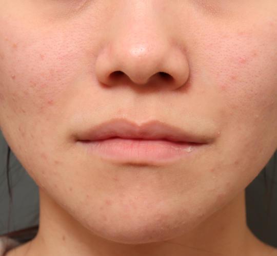 20代女性の鼻プロテーゼ Before 症例写真