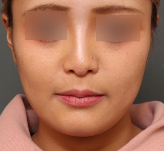 20代女性の鼻翼縮小（小鼻縮小） Before 症例写真