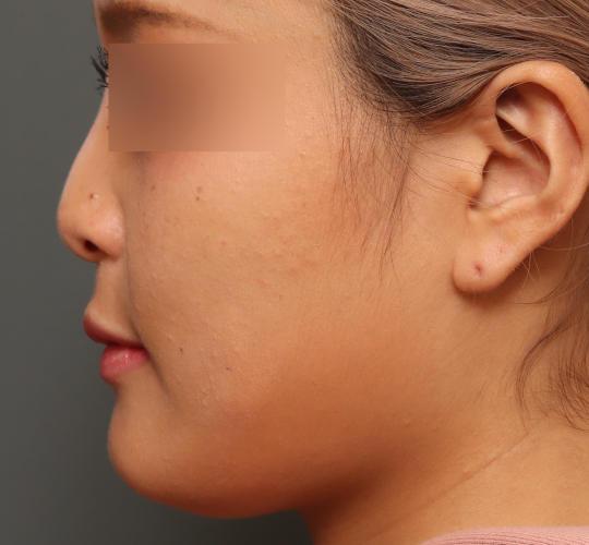 20代女性の鼻翼縮小（小鼻縮小） Before 症例写真