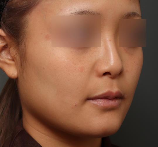 20代女性の鼻翼縮小（小鼻縮小） Before 症例写真