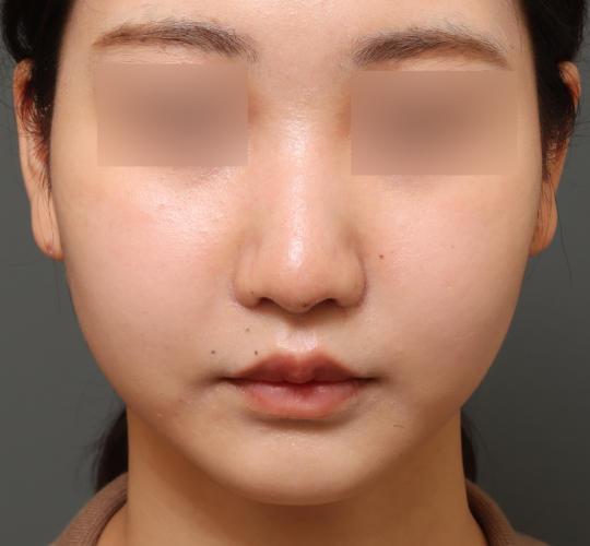 20代女性の鼻翼縮小（小鼻縮小） After 症例写真