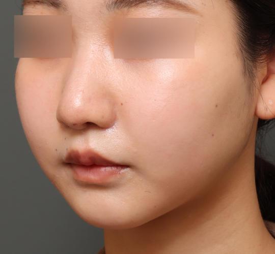 20代女性の鼻翼縮小（小鼻縮小） After 症例写真
