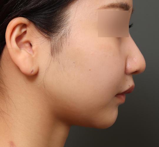 20代女性の鼻翼縮小（小鼻縮小） After 症例写真