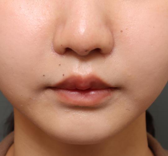 20代女性の鼻翼縮小（小鼻縮小） After 症例写真