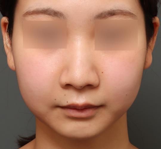 20代女性の鼻翼縮小（小鼻縮小） Before 症例写真