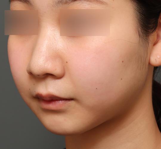 20代女性の鼻翼縮小（小鼻縮小） Before 症例写真