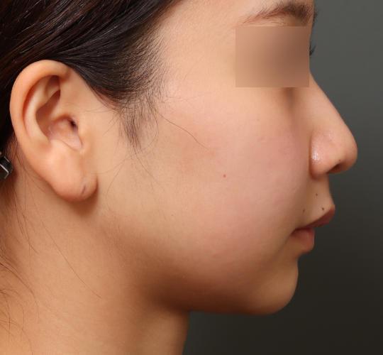 20代女性の鼻翼縮小（小鼻縮小） Before 症例写真