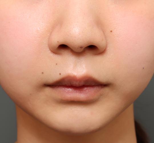 20代女性の鼻翼縮小（小鼻縮小） Before 症例写真