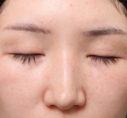 20代女性の全切開二重まぶた法 After 症例写真