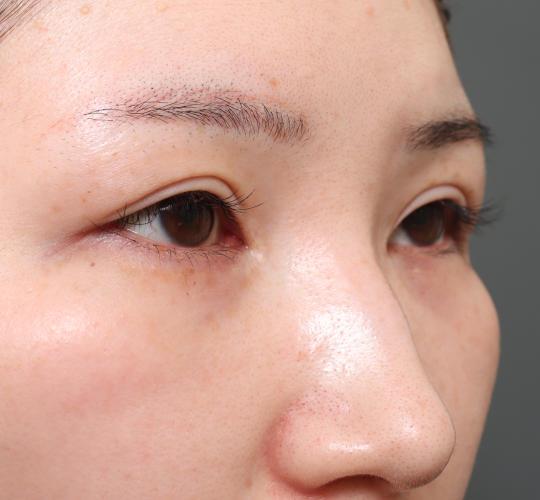 20代女性の全切開二重まぶた法 After 症例写真