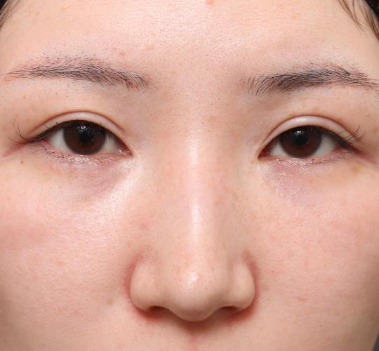 20代女性の二重整形・目元の整形 After 症例写真