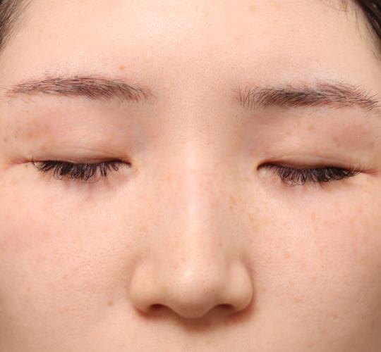 20代女性の全切開二重まぶた法 Before 症例写真