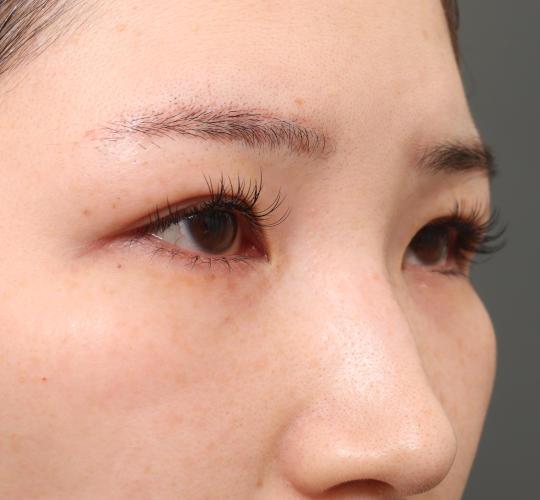 20代女性の全切開二重まぶた法 Before 症例写真