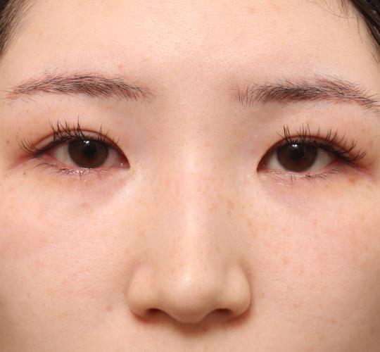 20代女性の二重整形・目元の整形 Before 症例写真