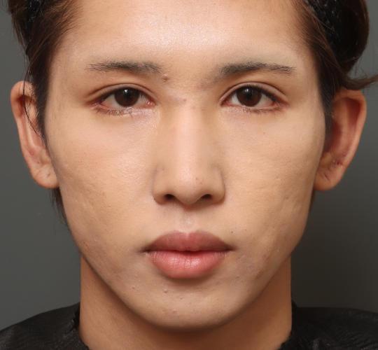 10代男性の目つき矯正 After 症例写真