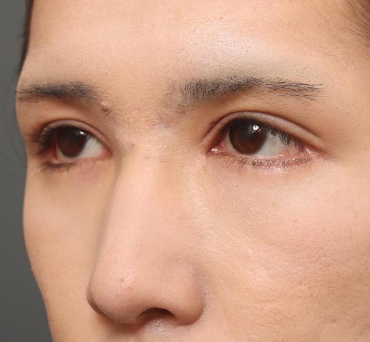 10代男性の目つき矯正 After 症例写真