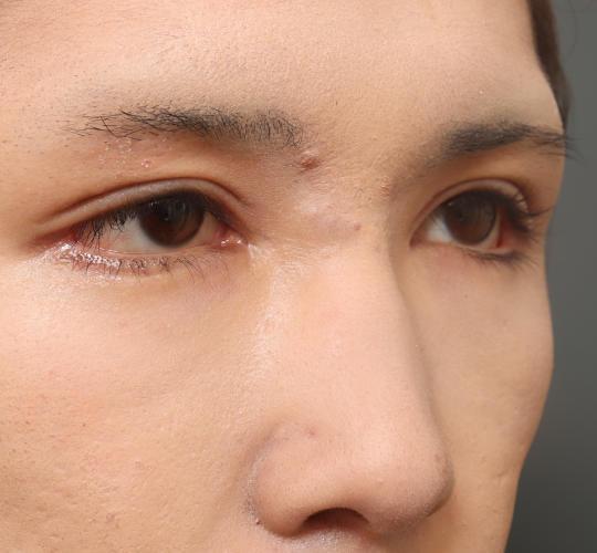 10代男性の目つき矯正 After 症例写真