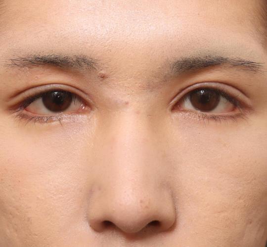 10代男性の二重整形・目元の整形 After 症例写真