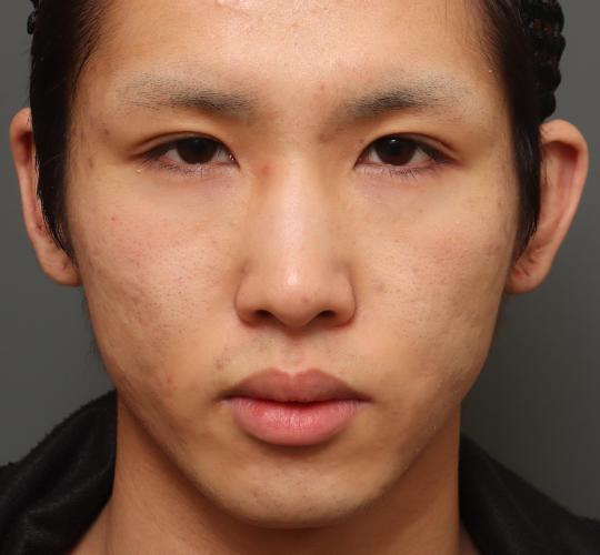 10代男性の目つき矯正 Before 症例写真