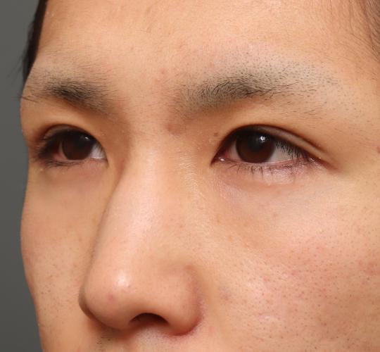 10代男性の目つき矯正 Before 症例写真