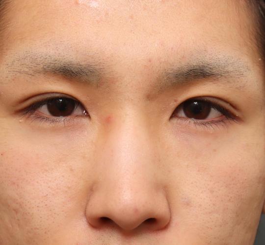 10代男性の二重整形・目元の整形 Before 症例写真