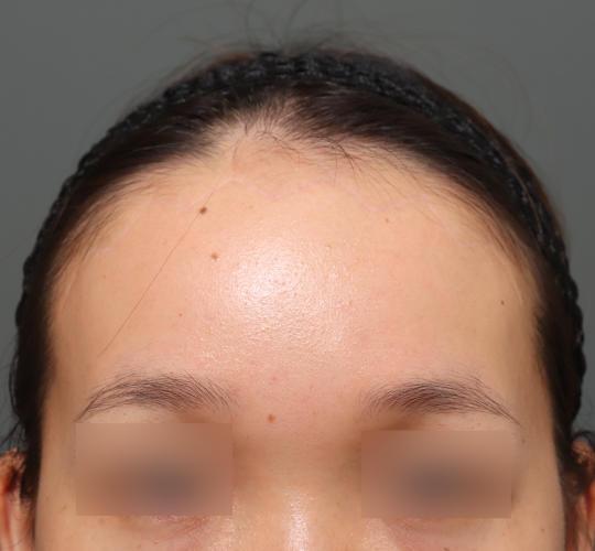 20代女性のエラ・アゴ・小顔 After 症例写真