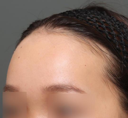 20代女性の額縮小 After 症例写真