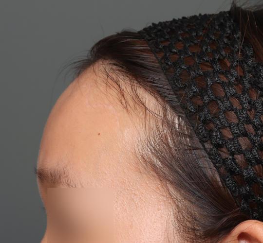 20代女性の額縮小 After 症例写真