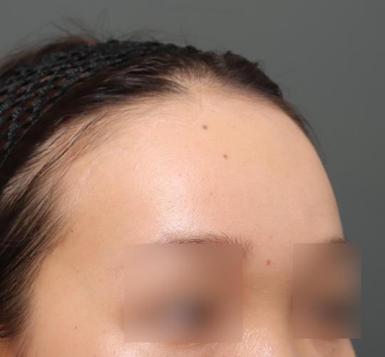 20代女性の額縮小 After 症例写真