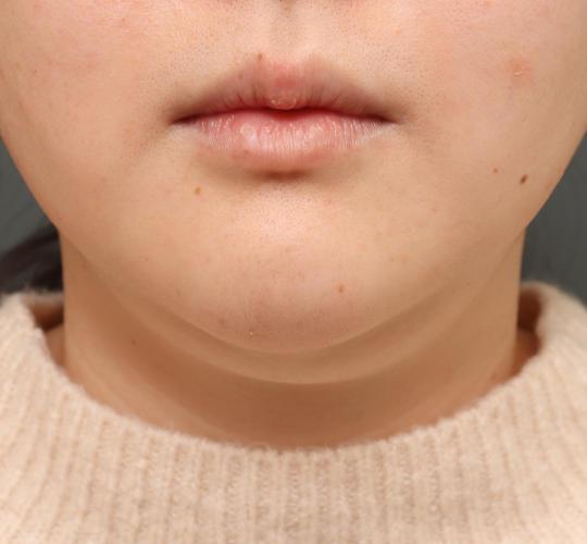 20代女性の二重アゴ筋肉縛り（ペリカン手術） Before 症例写真