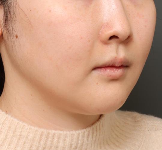 20代女性の二重アゴ筋肉縛り（ペリカン手術） Before 症例写真