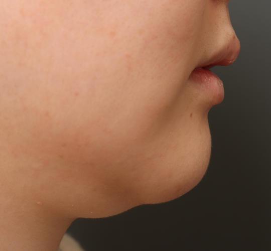 20代女性の二重アゴ筋肉縛り（ペリカン手術） Before 症例写真