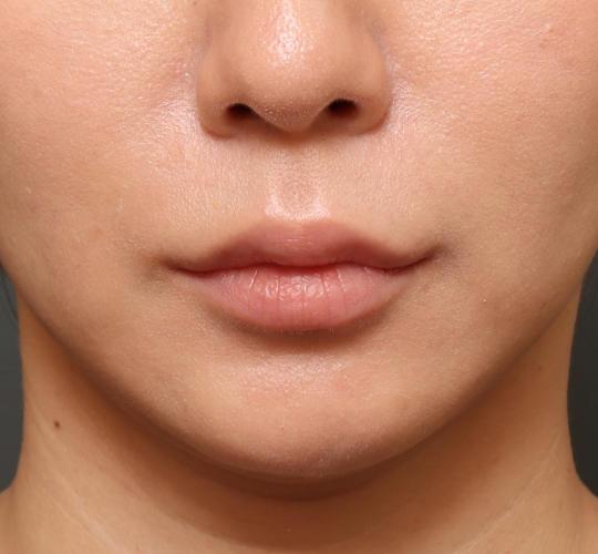 30代女性の人中短縮ボトックス After 症例写真