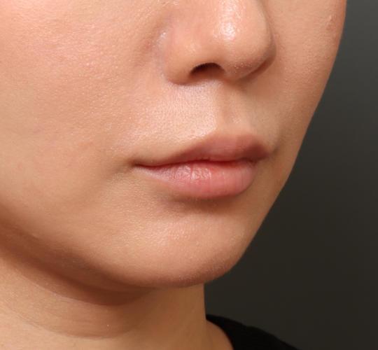 30代女性の人中短縮ボトックス After 症例写真