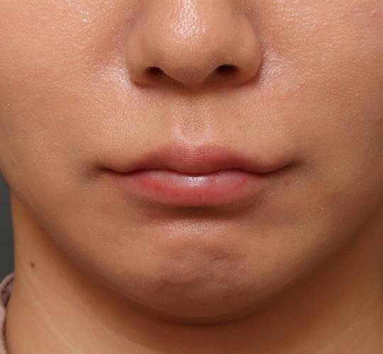 30代女性の人中短縮ボトックス Before 症例写真