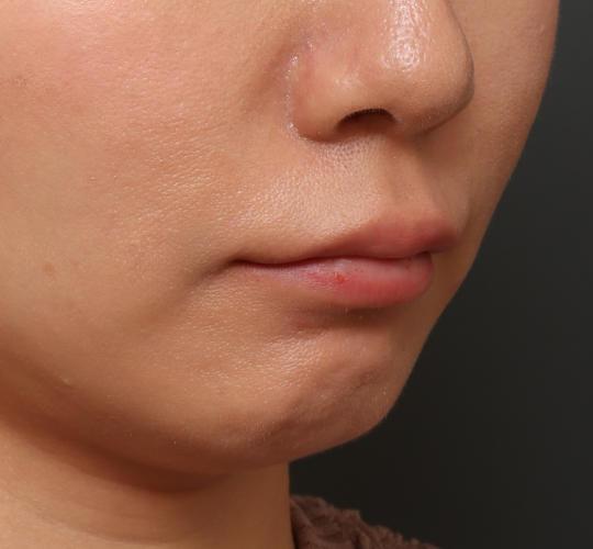 30代女性の人中短縮ボトックス Before 症例写真