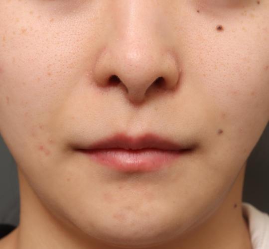 20代女性の人中短縮(リップリフト) After 症例写真