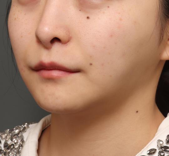 20代女性の人中短縮(リップリフト) After 症例写真