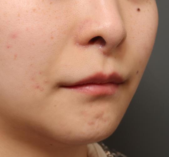 20代女性の鼻の整形 After 症例写真
