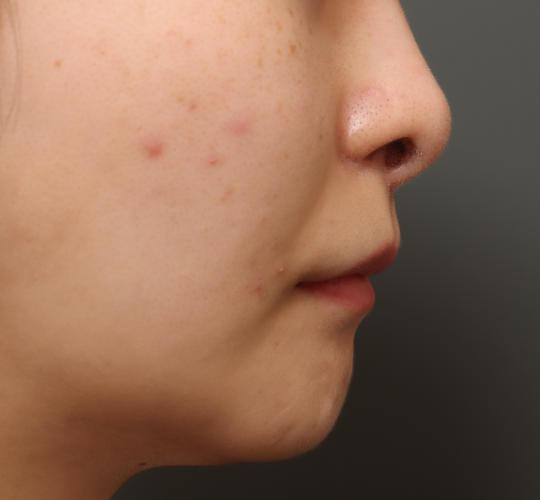 20代女性の人中短縮(リップリフト) After 症例写真