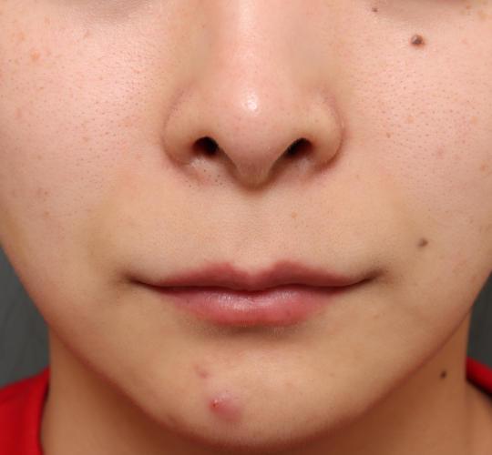 20代女性の人中短縮(リップリフト) Before 症例写真