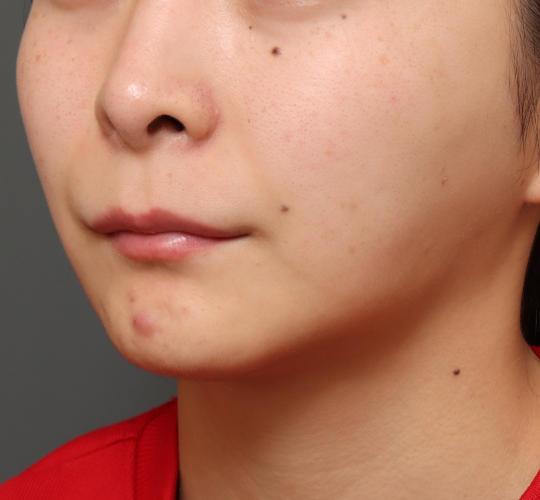 20代女性の人中短縮(リップリフト) Before 症例写真