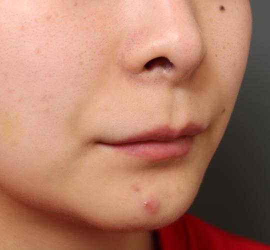 20代女性の鼻の整形 Before 症例写真