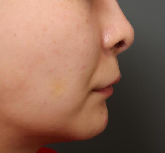 20代女性の人中短縮(リップリフト) Before 症例写真