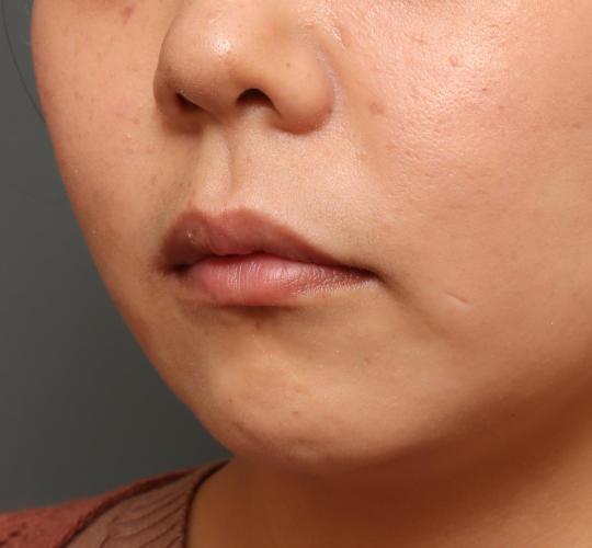 30代女性の人中短縮ボトックス After 症例写真