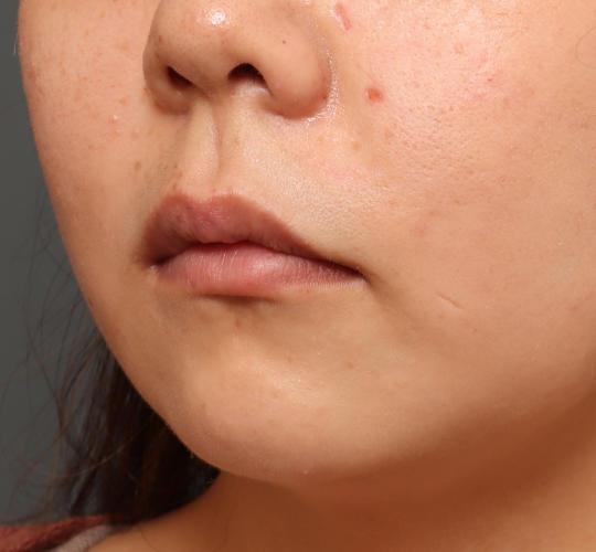 30代女性の人中短縮ボトックス Before 症例写真