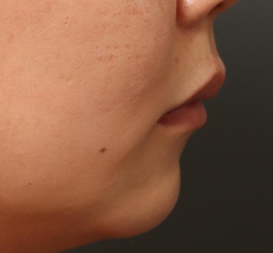 30代女性の人中短縮ボトックス Before 症例写真