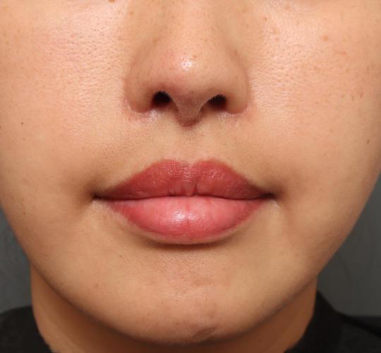 30代女性の耳介軟骨移植 After 症例写真