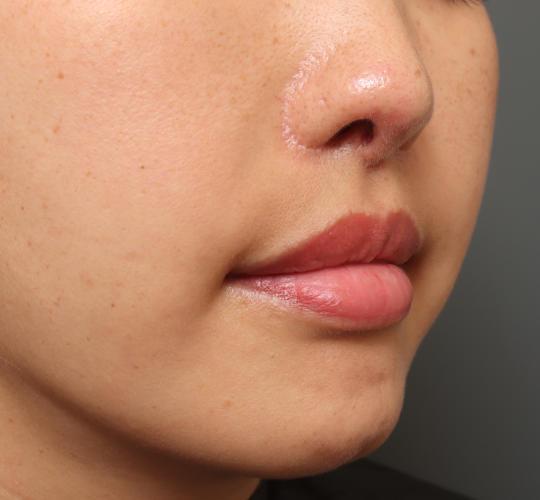 30代女性の耳介軟骨移植 After 症例写真