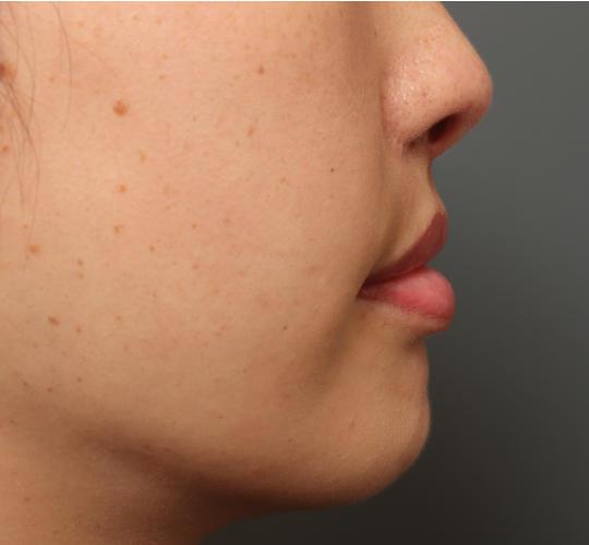 30代女性の耳介軟骨移植 After 症例写真